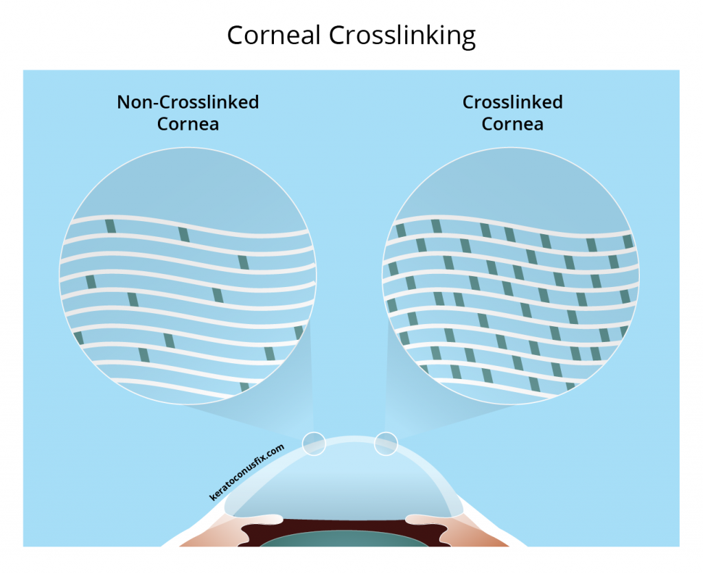 Corneal Crosslinking