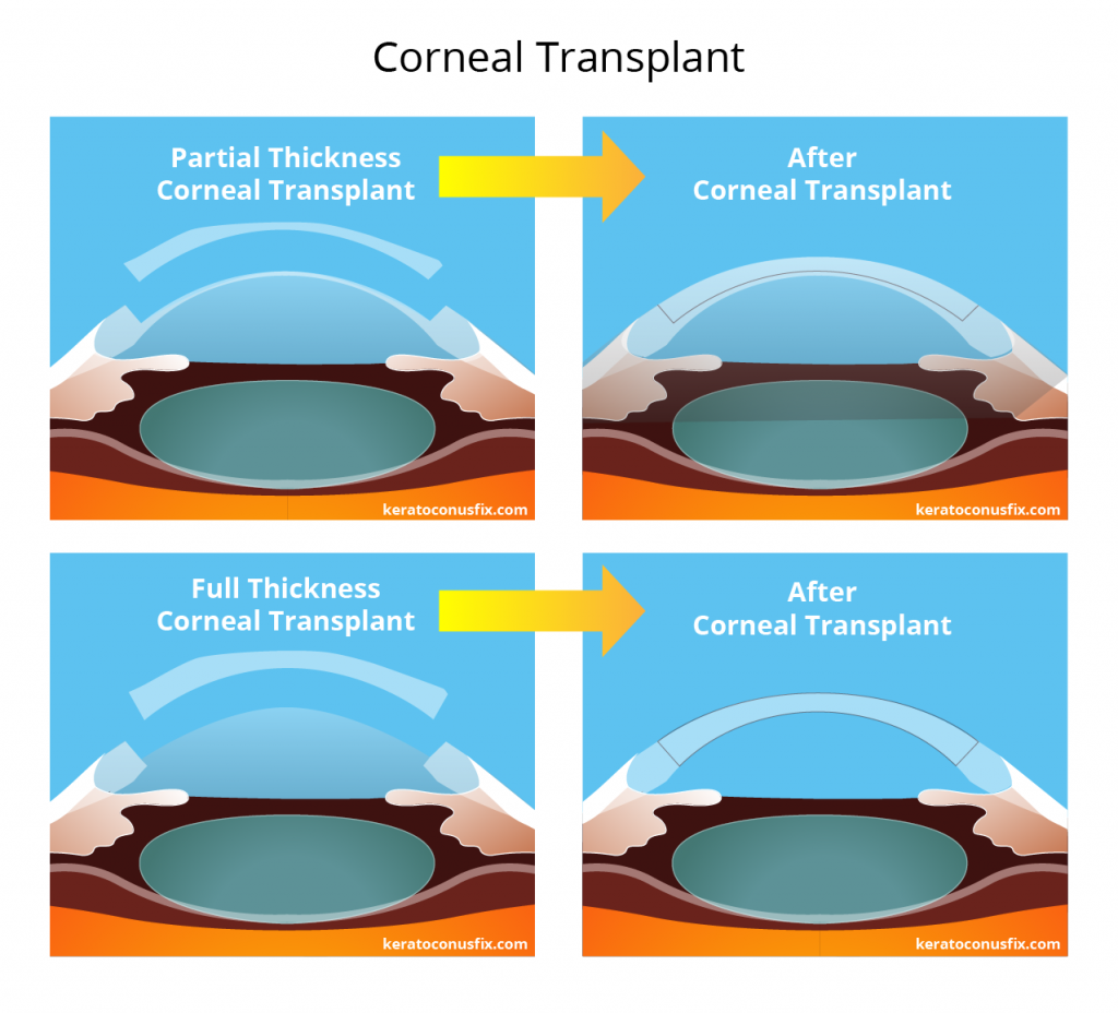 Corneal Transplant