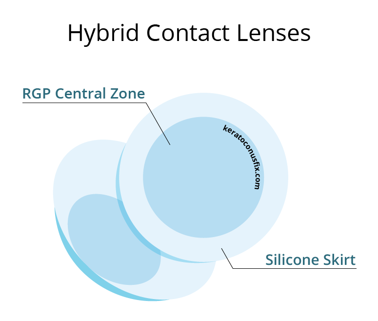 Hybrid Contact Lenses