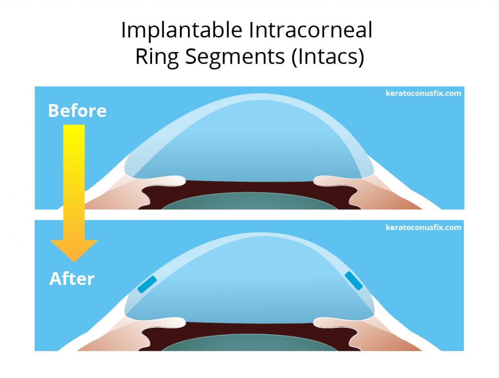 Implantable Intracorneal Ring Segments (Intacs)