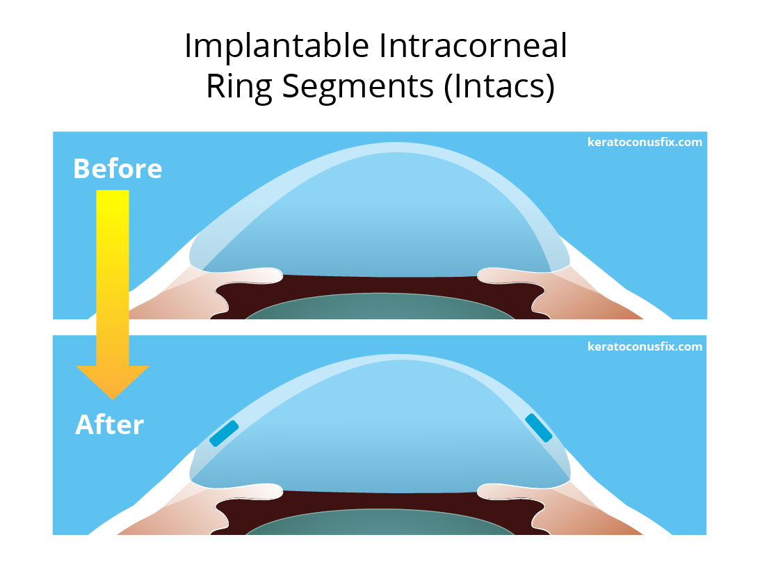 Surgical Treatments For Keratoconus Custom Sclerals