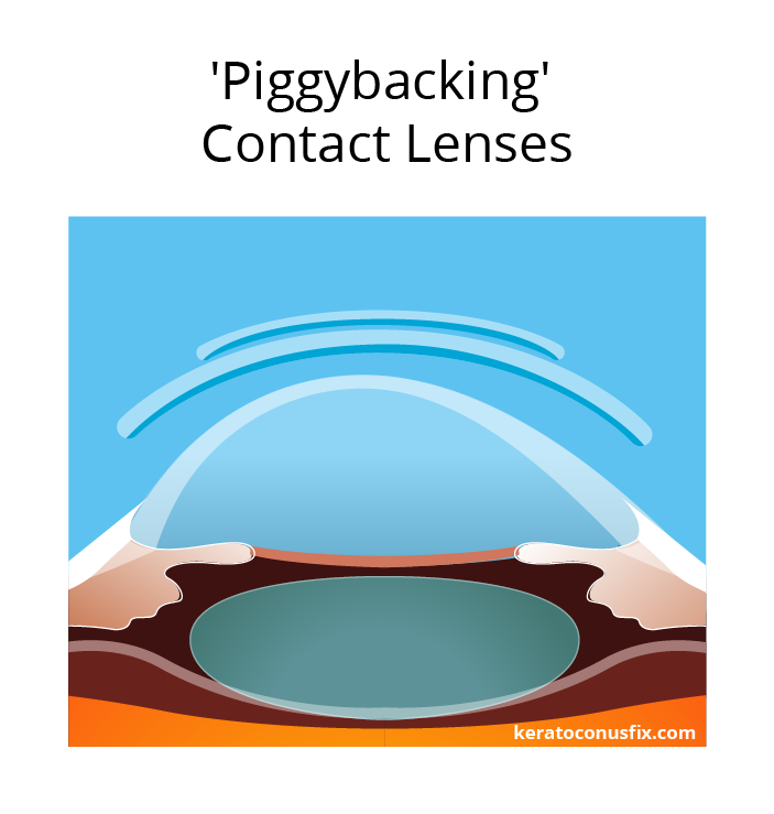 'Piggybacking' Contact Lenses