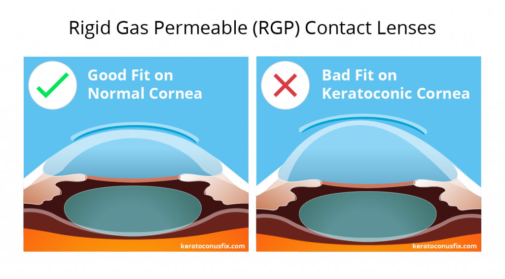 rigid gas permeable (RGP) contact lenses