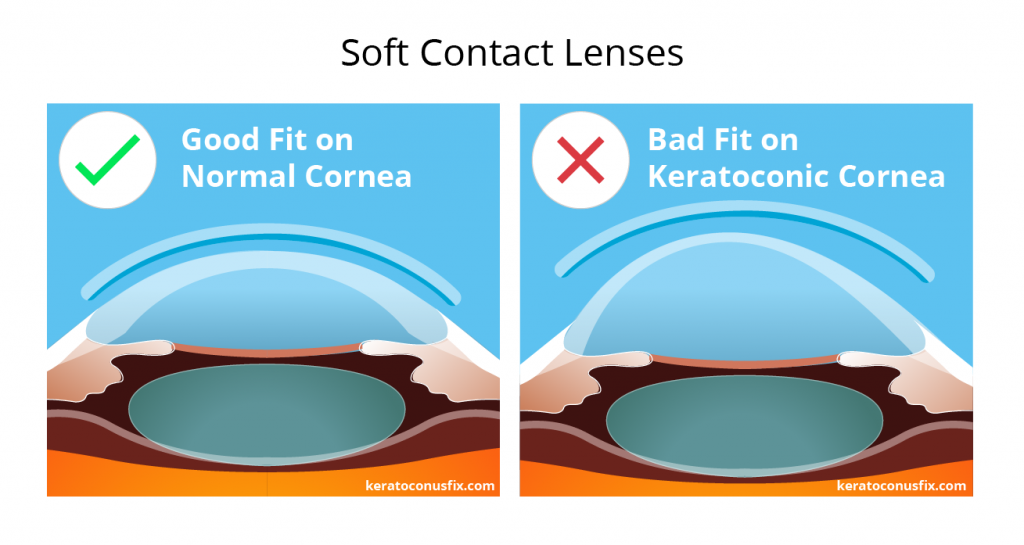 soft contact lenses