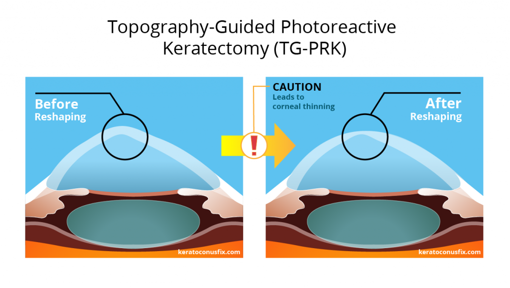 Topography-Guided Photoreactive Keratectomy