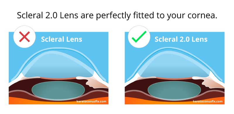 Scleral 2.0 Lens are perfectly fitted to your cornea